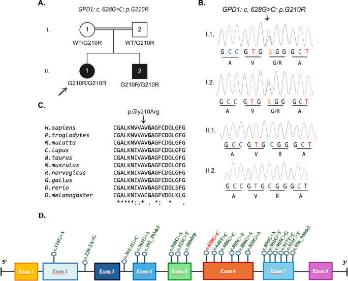 GPD1 deficiency—a rare, overlooked cause of liver disease