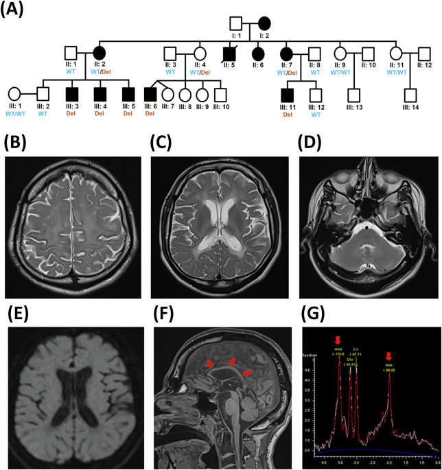 A copy number variant overlapping the 3ʹUTR of PLP1 causes spastic paraplegia