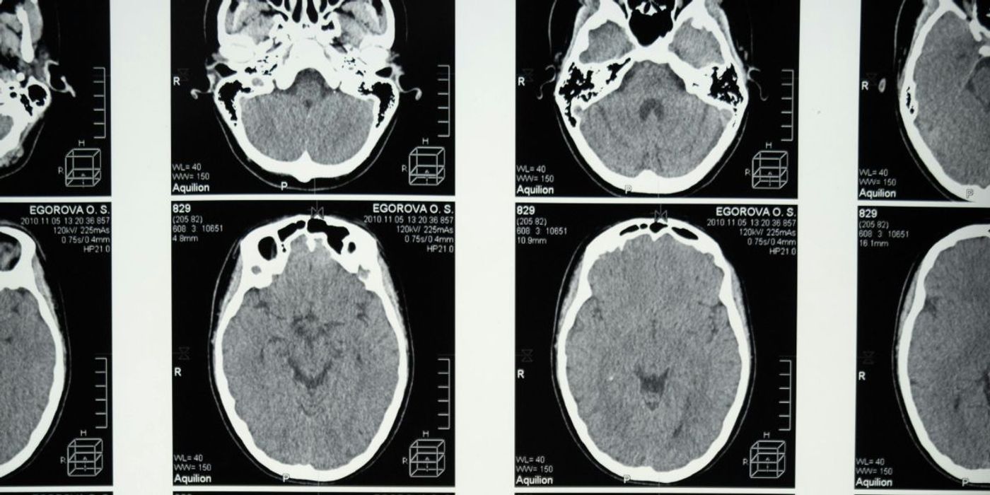 Subsequent Stroke Risk Up to 20% Higher After Minor Stroke
