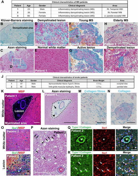 Type I collagen secreted in white matter lesions inhibits remyelination and functional recovery
