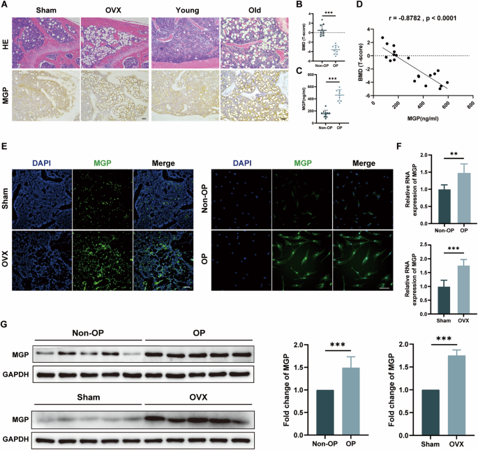 MGP regulates the adipogenic differentiation of mesenchymal stem cells in osteoporosis via the Ca2+/CaMKII/RIP140/FABP3 axis