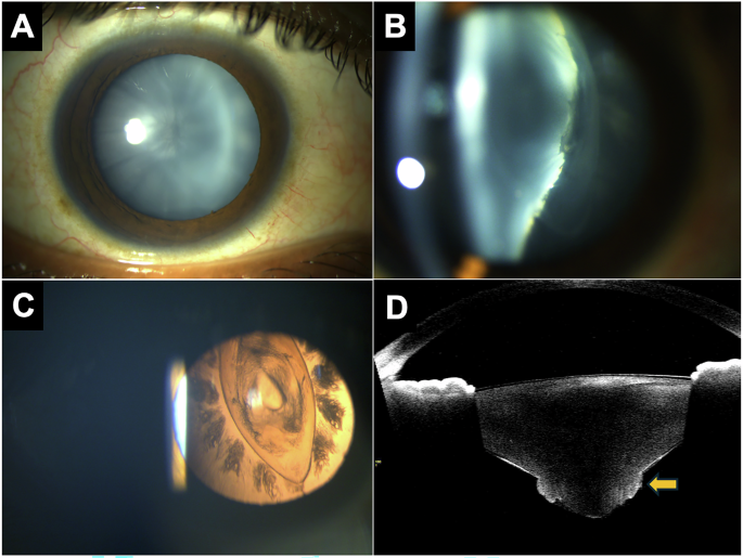 Deciphering shuttlecock cataract morphology using anterior segment optical coherence tomography