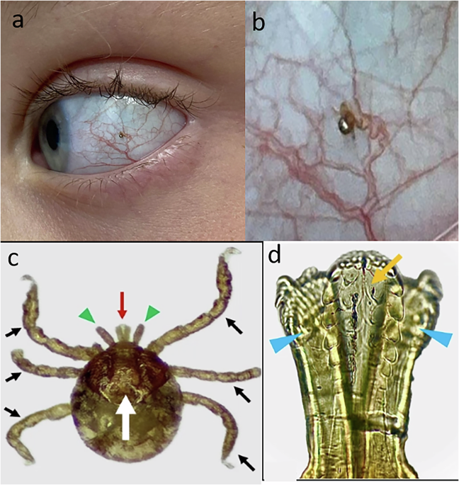 Conjunctival tick bite