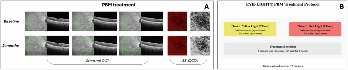 Photobiomodulation-induced choriocapillaris perfusion enhancement and outer retinal remodelling in intermediate age-related macular degeneration: a promising therapeutic approach with short-term results