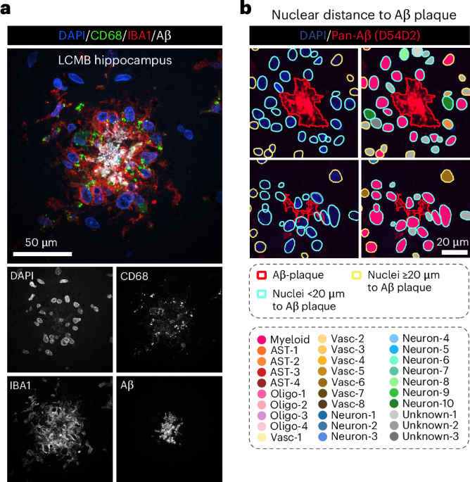 Microglia drive amyloid-β clearance in immunized patients with Alzheimer’s disease