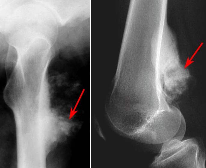 Improved gated recurrent unit-based osteosarcoma prediction on histology images: a meta-heuristic-oriented optimization concept
