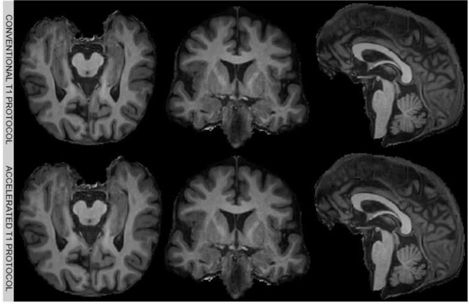 Reliability assessment of accelerated MR sequences for the estimation of structural and vascular markers in dementia