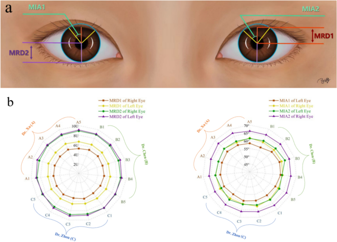 Deep learning based adaptive and automatic measurement of palpebral margin in eyelid morphology