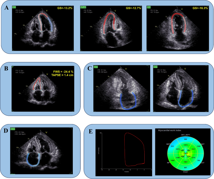 Prognostic implications of multiple chamber longitudinal strains and myocardial work in restrictive cardiomyopathy