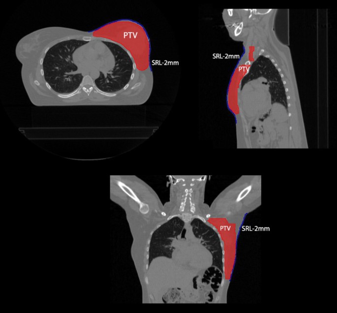 Prediction of acute skin toxicity in tomotherapy of breast cancer using skin DVH data