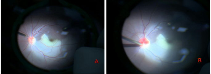 Central retinal artery catheterization for retinal artery occlusion with balanced salt solution