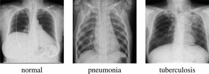 Addressing cross-population domain shift in chest X-ray classification through supervised adversarial domain adaptation