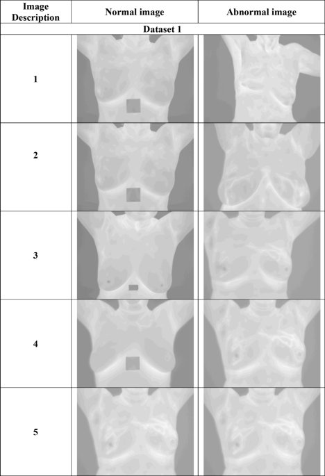 Efficient hybrid heuristic adopted deep learning framework for diagnosing breast cancer using thermography images