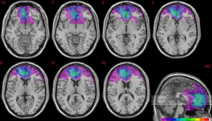 The role of vmPFC in accessing the temporality of life events for mental time travel