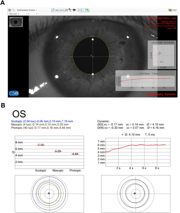 Measurement of static and dynamic pupillary characteristics after implantable collamer lens by sirius anterior segment analysis system