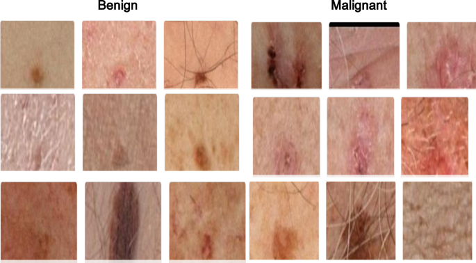 SkinEHDLF a hybrid deep learning approach for accurate skin cancer classification in complex systems