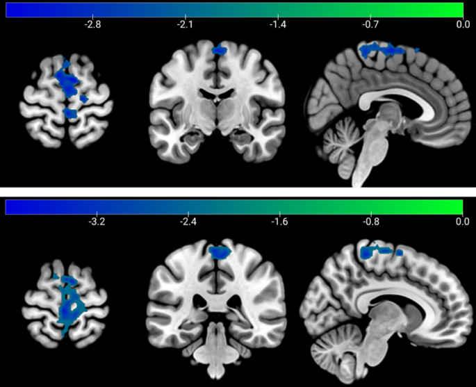 Striatal functional connectivity associated with Sahaja Yoga meditation