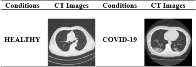 Metaheuristic optimizers integrated with vision transformer model for severity detection and classification via multimodal COVID-19 images