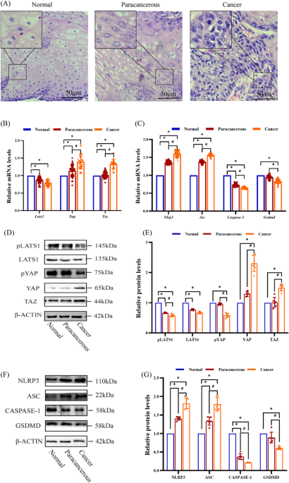Down-regulation of YAP prevents smoking- and alcohol-induced carcinogenesis of esophageal paracancerous tissue by promoting cellular pyroptosis