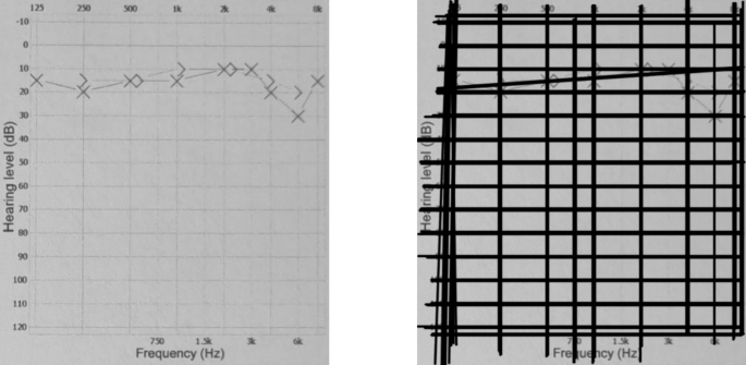 Development and testing of an open source mobile application for audiometry test result analysis and diagnosis support