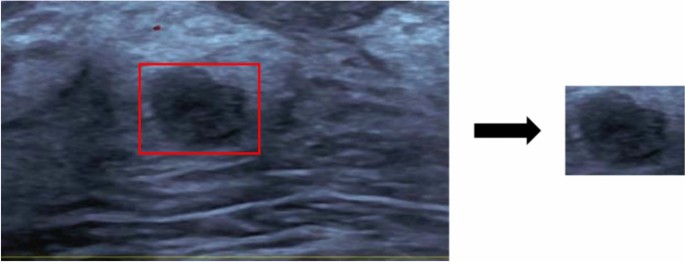 A deep learning-based multimodal medical imaging model for breast cancer screening