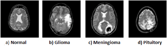 Brain tumor detection empowered with ensemble deep learning approaches from MRI scan images