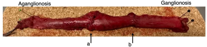 The use of ultra-high frequency ultrasound in identifying aganglionosis in Hirschsprung’s disease