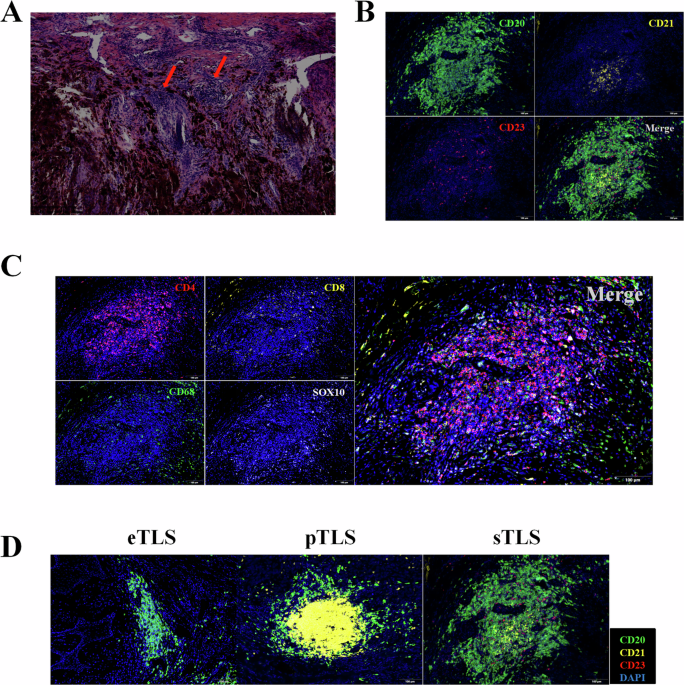 Tertiary lymphoid structures associated with improved survival and enhanced antitumor immunity in acral melanoma