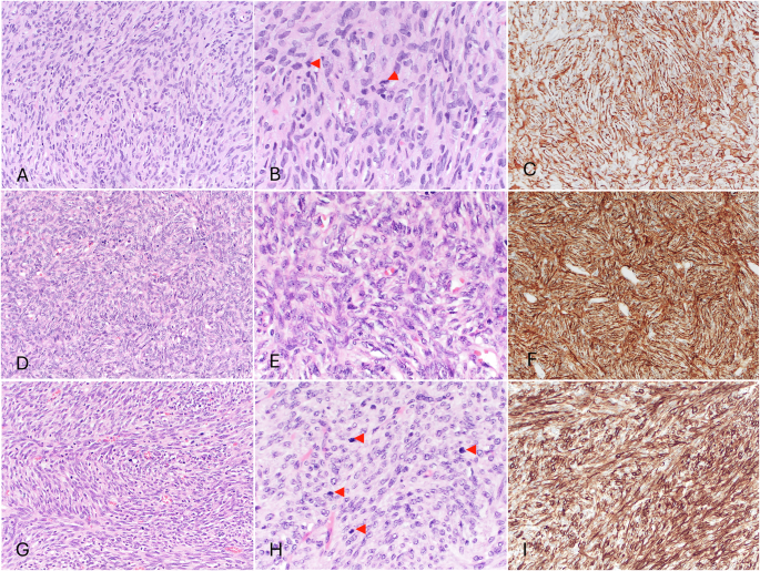 Clinicopathological and molecular analysis of a dermatofibrosarcoma protuberans with fibrosarcomatous transformation in the breast