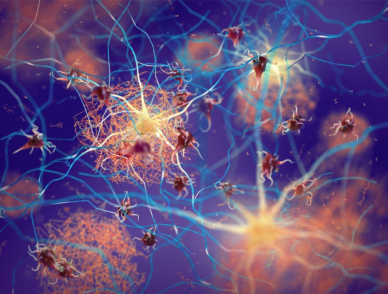 Anti-amyloid could help prevent genetic form of Alzheimer’s disease