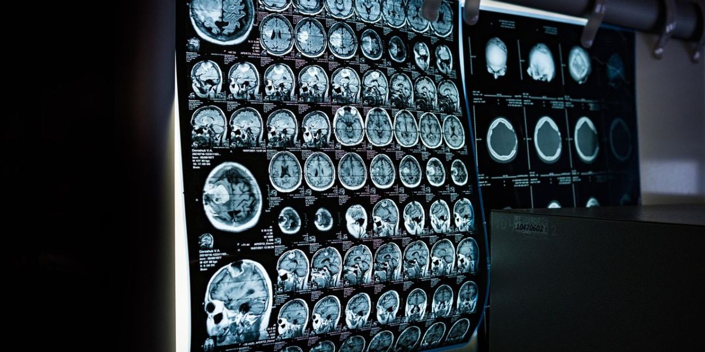 Experimental Drug Cuts Alzheimer’s Risk by 50%