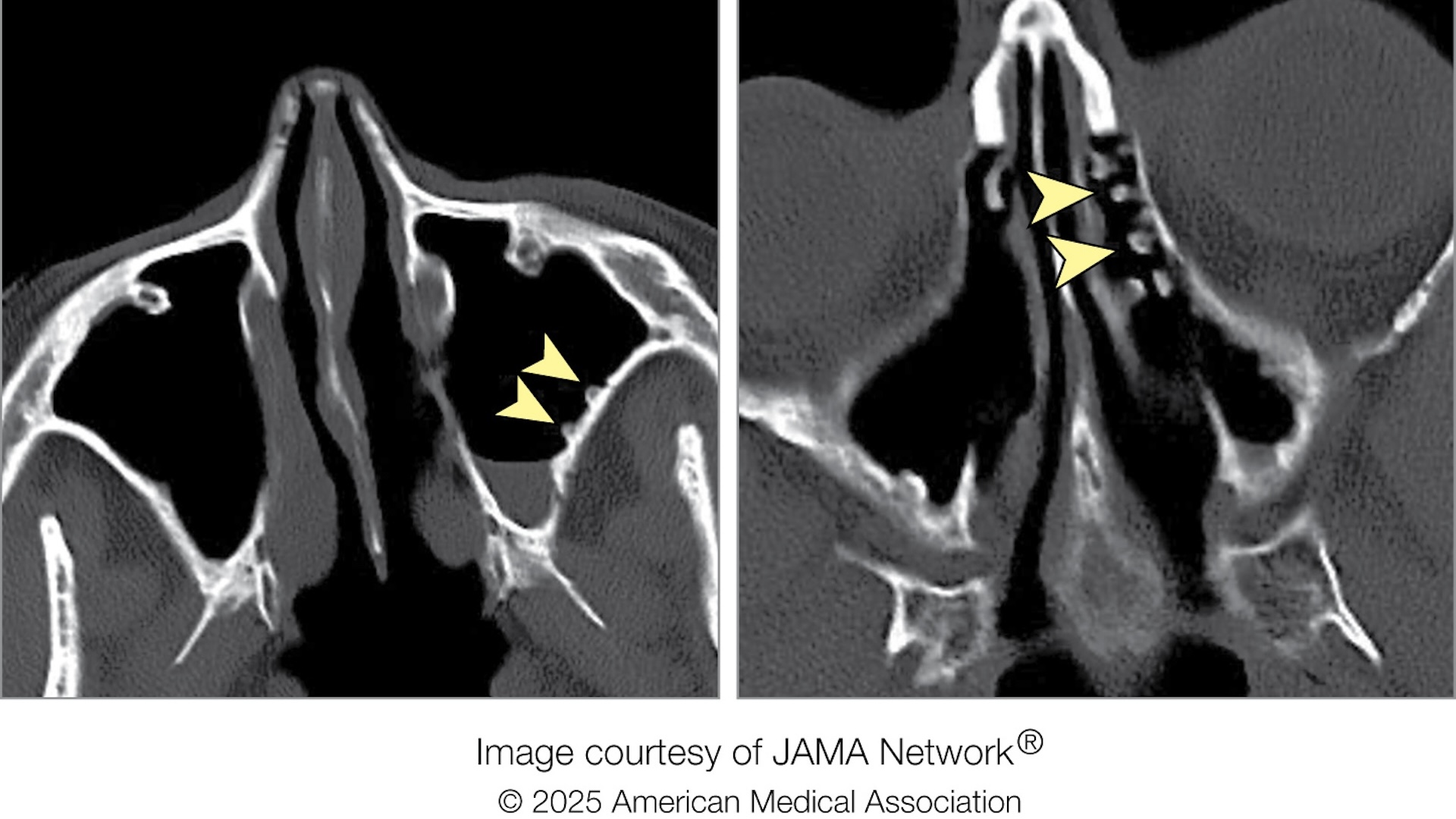 Diagnostic dilemma: Cold-water rinses left ‘cobblestone’ growths in woman’s sinuses