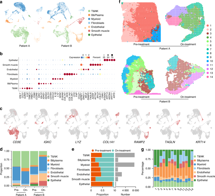 Single-cell and spatial transcriptomics reveals an anti-tumor neutrophil subgroup in microwave thermochemotherapy-treated lip cancer