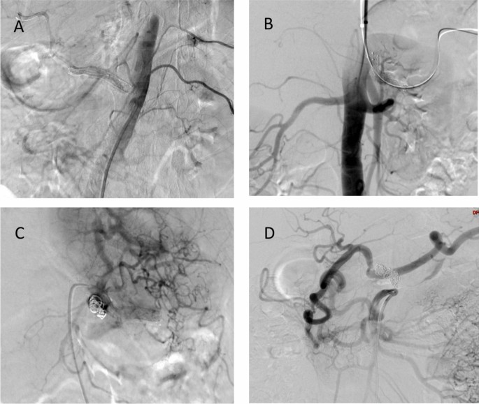 Presentation, treatment, and outcomes in patients with spontaneous isolated celiac artery dissection