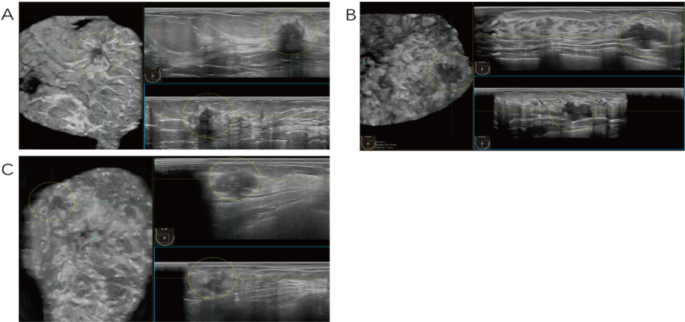 Innovative integration of automated breast volume scan and ultrasound elastography for enhanced differentiation of benign and malignant breast lesions