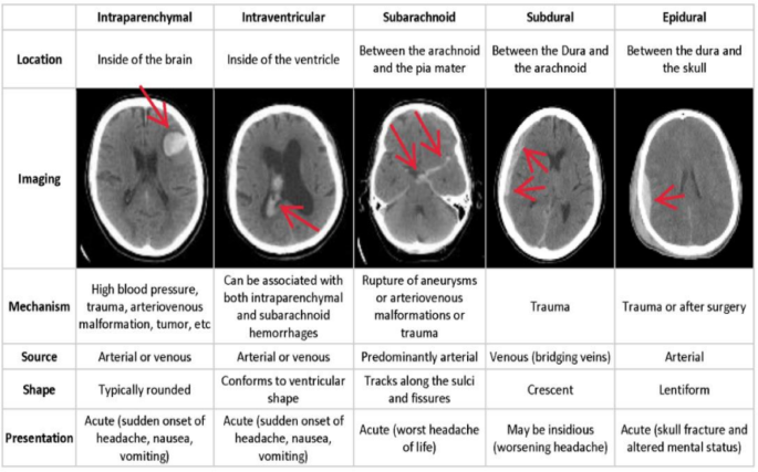 Intracranial hemorrhage segmentation and classification framework in computer tomography images using deep learning techniques