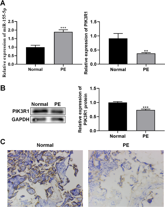 The mechanism of miR-155 targeting PIK3R1 in the pathogenesis of preeclampsia