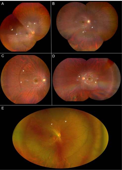 Multimodal imaging of dark without pressure in high myopia reveals evidence that photoreceptor microscopic lesions may be reversible