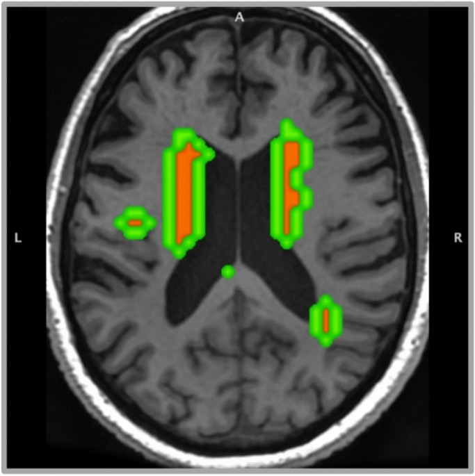 Microstructural and microvascular features of white matter hyperintensities and their association with small vessel disease markers