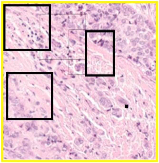 Histopathological image based breast cancer diagnosis using deep learning and bio inspired optimization