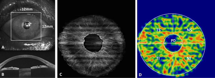 Assessment of iris vasculature in type 2 diabetes mellitus patients without diabetic retinopathy using anterior segment optical coherence tomography angiography