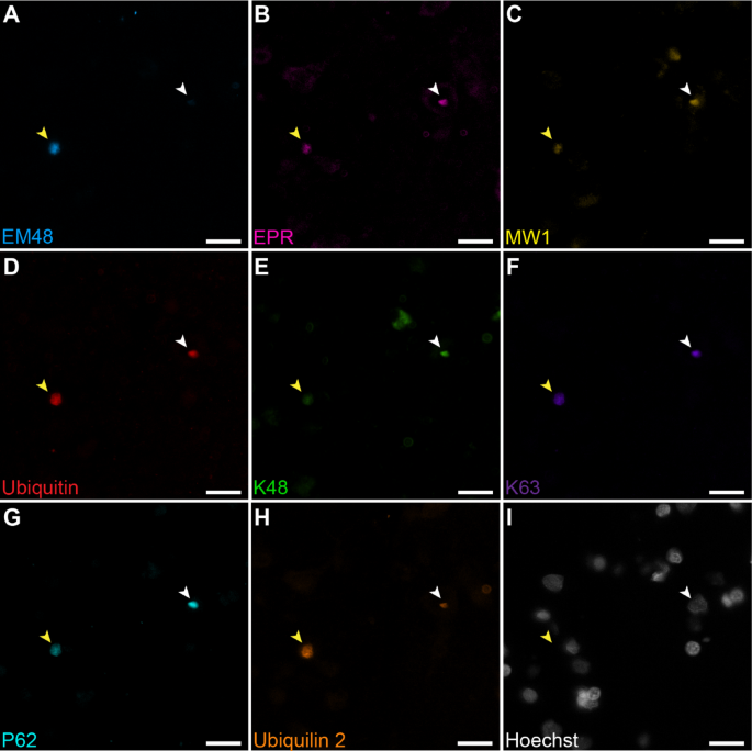 Huntingtin inclusion bodies have distinct immunophenotypes and ubiquitination profiles in the Huntington’s disease human cerebral cortex