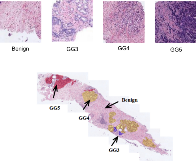 Enhanced hierarchical attention mechanism for mixed MIL in automatic Gleason grading and scoring