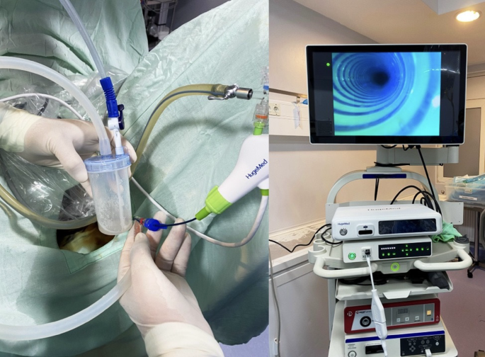 Early clinical outcomes using a 6.3 Fr single use ureteroscope compared to a 7.5 Fr device