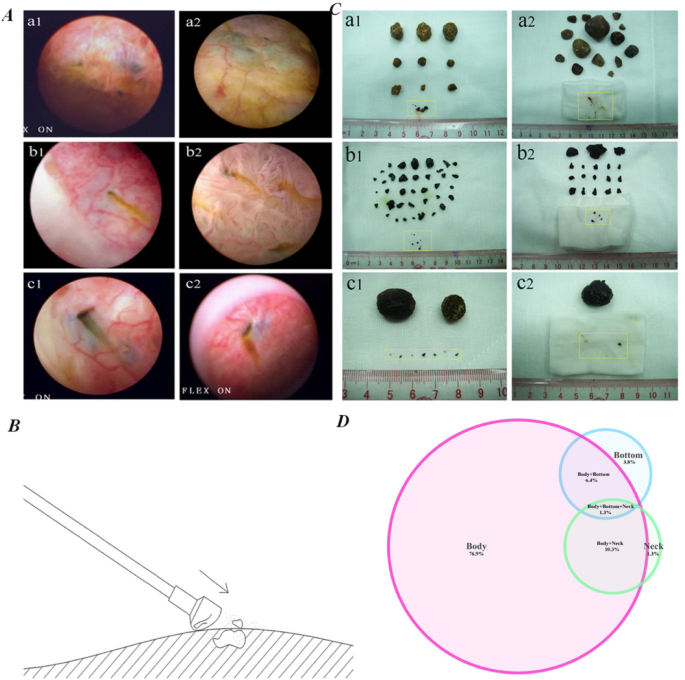 Research of the clinical features, risk factors, and surgical diagnosis of intramural stones in patients with gallbladder stones