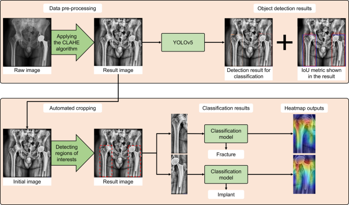 An automated hip fracture detection, classification system on pelvic radiographs and comparison with 35 clinicians