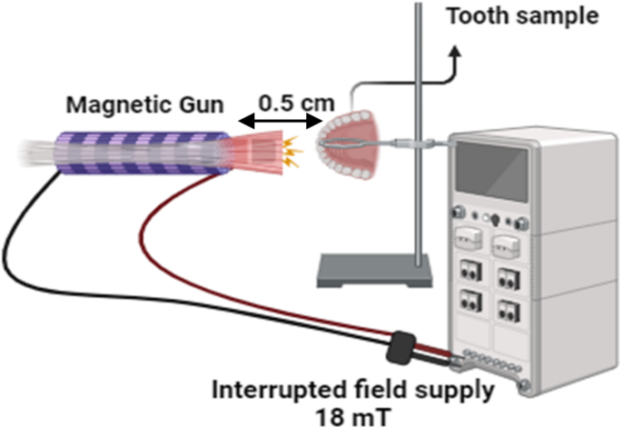 A synergistic approach to tooth remineralization using nano-chitosan, fluoride, and pulsed magnetic field