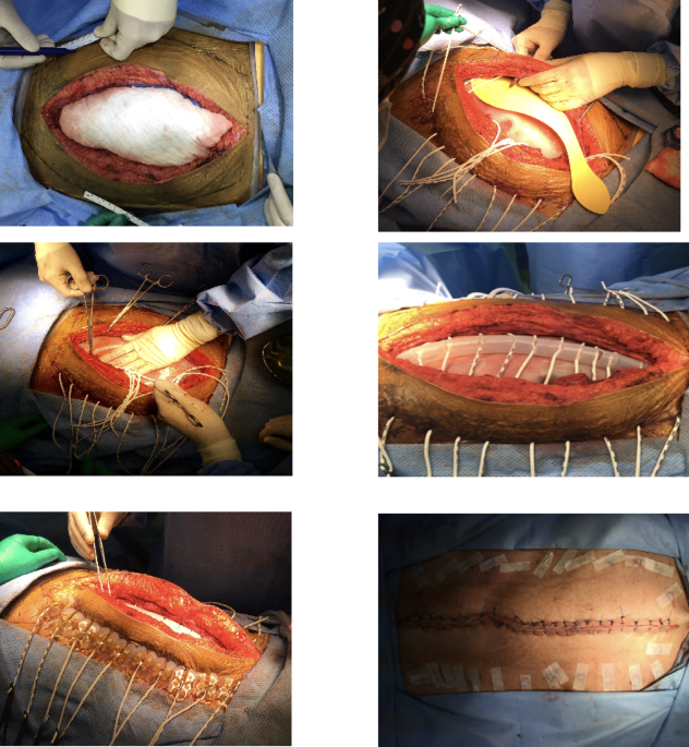 Early application of abdominal re-approximation anchor system for the management of the open abdomen