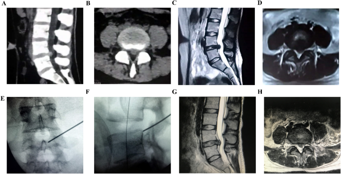 Clinical comparison of percutaneous endoscopic interlaminar vs. unilateral biportal endoscopic discectomy for lumbar disc herniation: a retrospective study