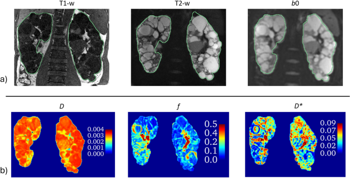 Reliability of radiomic analysis on multiparametric MRI for patients affected by autosomal dominant polycystic kidney disease